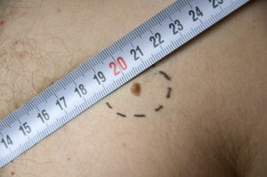 melanoma with hairs on Caucasian man skin with meter